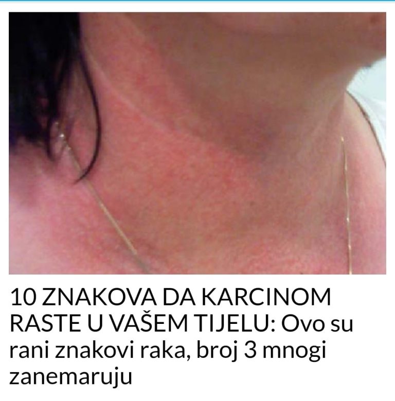 10 ZNAKOVA DA KARCINOM RASTE U VAŠEM TIJELU: Ovo su rani znakovi raka! - featured image